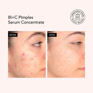 Bl+C Pimples • Cumin noir + Cajeput • Sérum concentré
