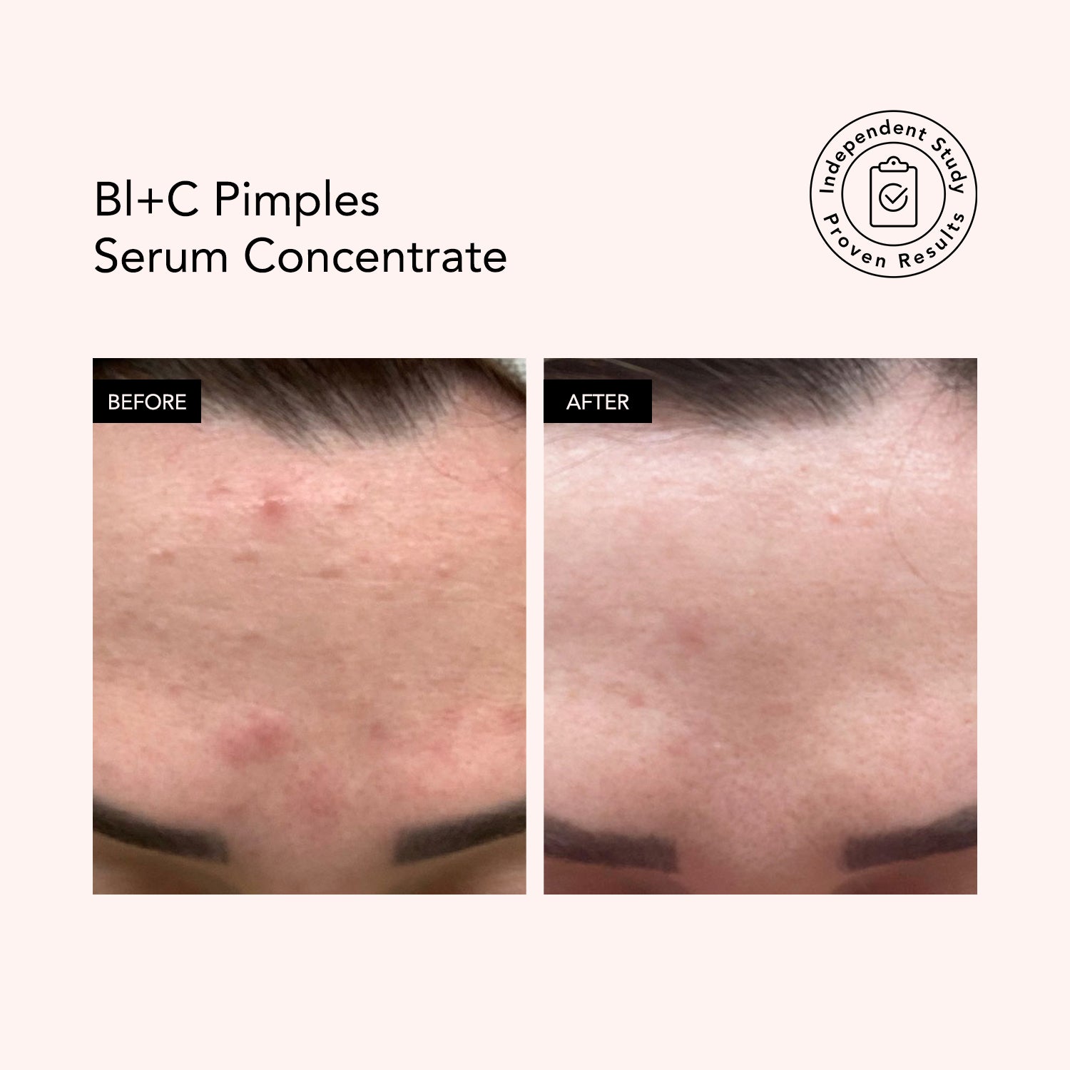 Bl+C Pimples Serum Concentrate | Black Cumin + Cajeput | Odacité