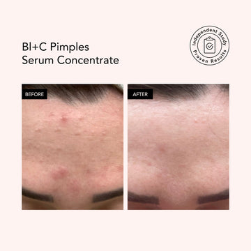 Bl+C Pimples • Cumin noir + Cajeput • Sérum concentré